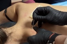 Иглорефлексотерапия цена