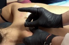 Иглорефлексотерапия цена