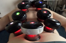 Вакуумна терапія