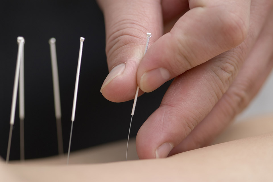 Голкотерапія Dry Needling